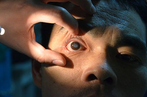 【十年】角膜穿孔患者，一周内可行角膜移植术
