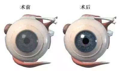 一眼万年几度轮回:华德眼科角膜移植全攻略