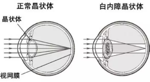 治疗白内障就一定要做手术吗？知道这些很重要！