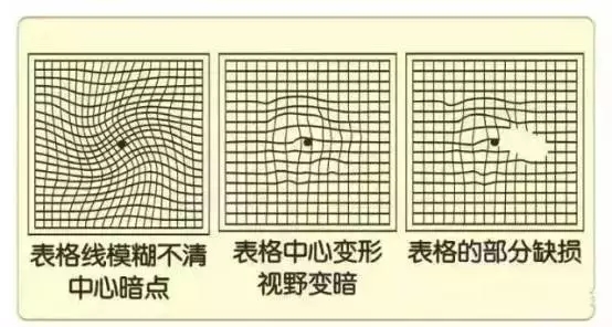 眼底病会引起的6大危害，看图自测眼底病。