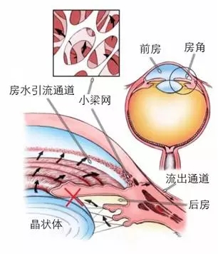 当青光眼遇上白内障，这场防盲保卫战该怎么打？