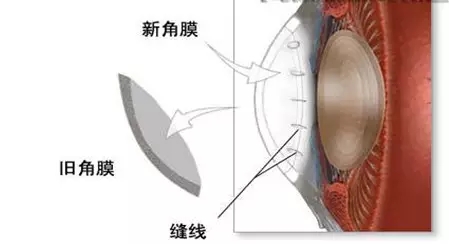 哪些眼病需要进行角膜移植手术?