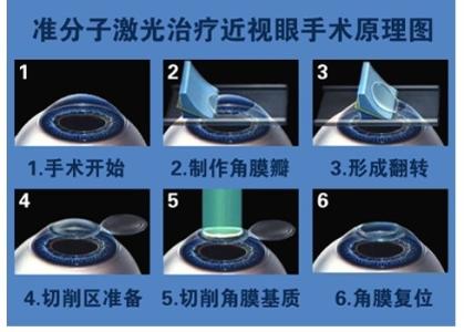 准分子手术临床技术操作规范