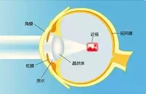 【ICL人工晶体植入术】跟高度近视眼如何“接轨”？