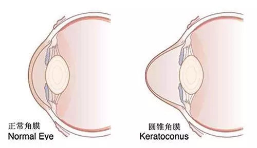 北京去哪治圆锥角膜好？！