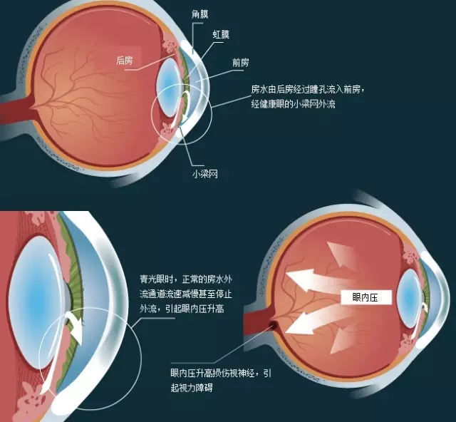 各类型青光眼原则