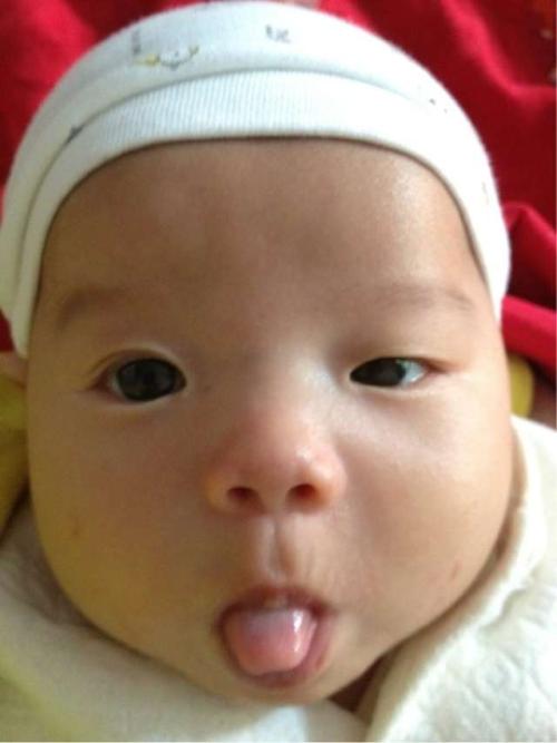 宝宝脸蛋不对称、大小眼，警惕上睑下垂！
