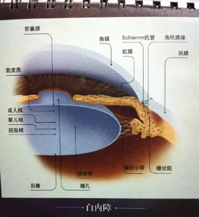 眼科医生：白内障早期症状和应对方法