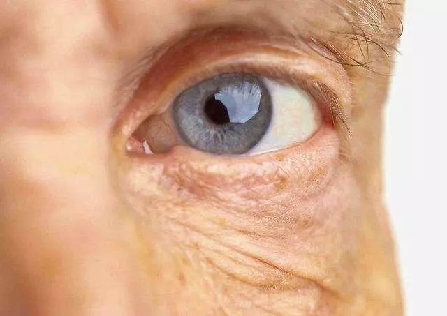 黄斑变性或致致盲：50岁以上人群每年都应检查