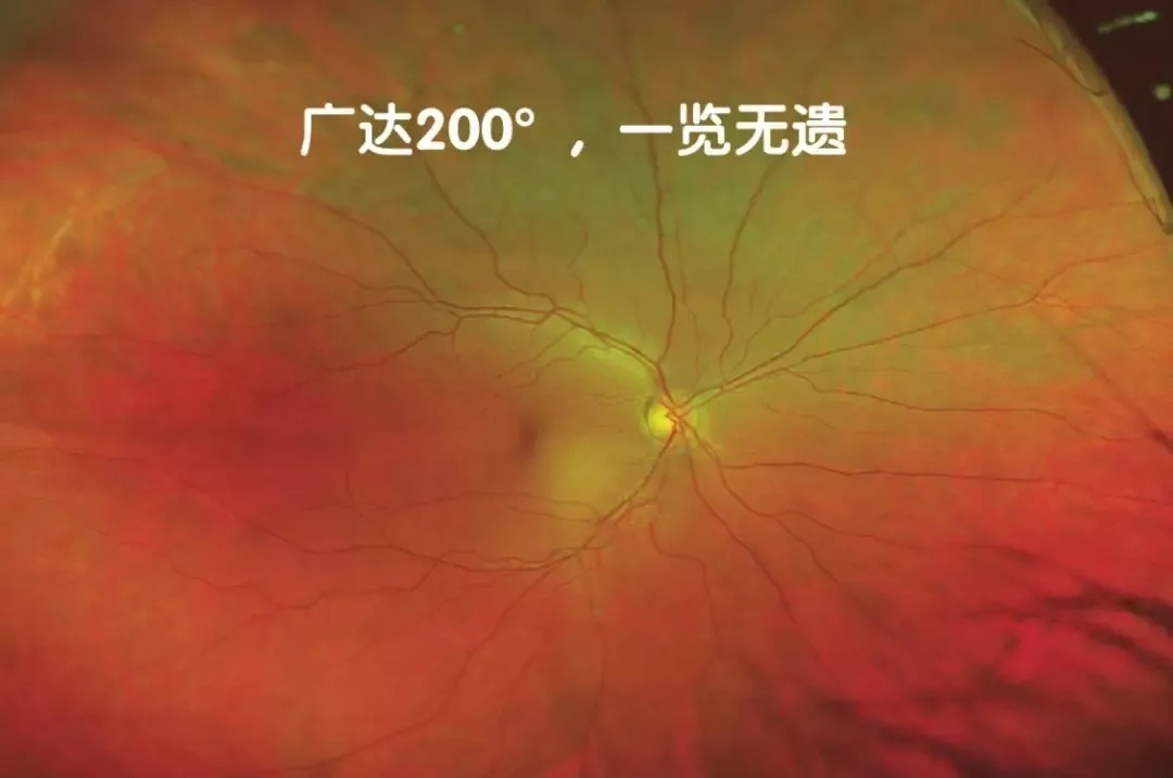 非接触、免散瞳、超广角眼底检查不是梦！